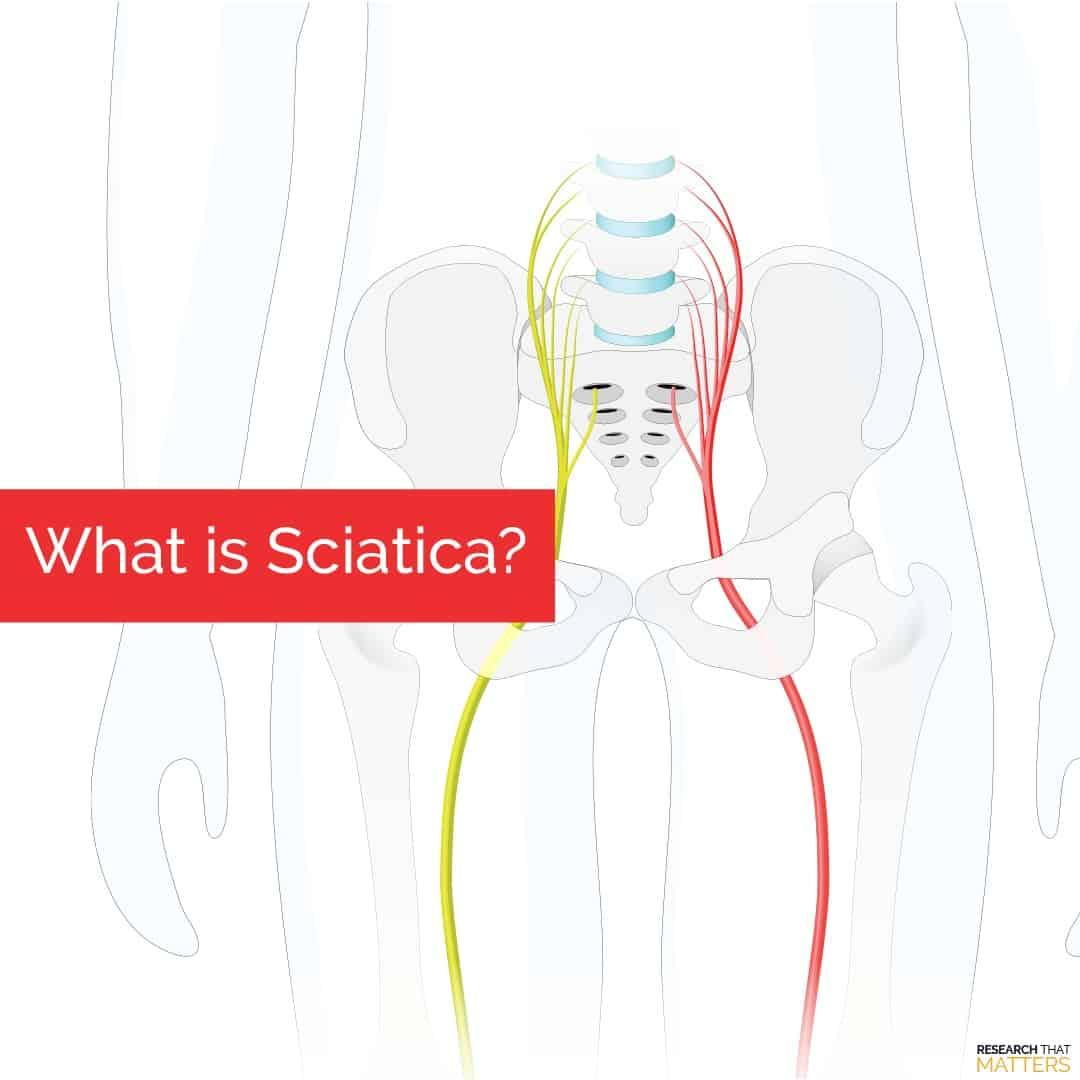 WHAT IS SCIATICA?